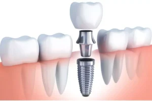 Why Alabama Residents Choose Dental Implants for Tooth Replacement