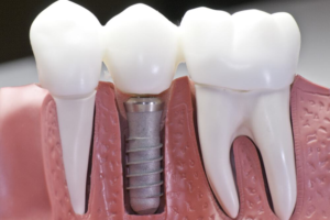 Everything You Need to Know About Dental Implants in Concord