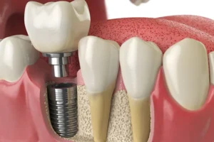 How Dental Implants in Marina del Rey Are Changing Smile Restoration in 2025