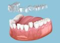 dental implants Tyldesley
