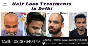 best hair fall treatment in delhi