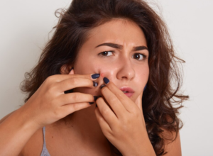 Simple Lifestyle Changes to Fight Acne