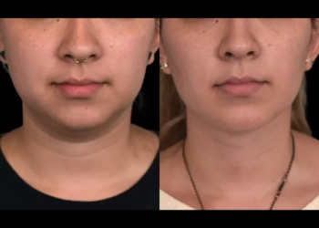Double chin removal