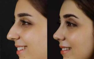 Septoplasty in Dubai