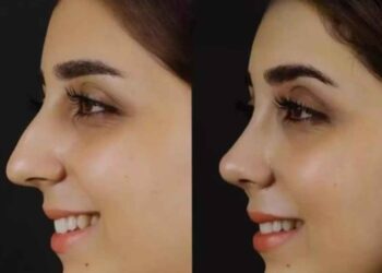 Septoplasty in Dubai