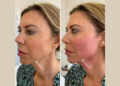 A Beginner’s Guide to Endolift Treatment in Dubai: What You Need to Know