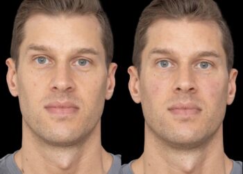 Under Eye Fillers in Dubai