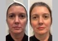 Thread Lift in Dubai: Non Surgical Fast and Effective Skin Rejuvenation Treatment