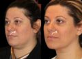 sculptra in dubai