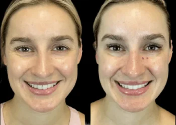 Seasonal Botox Trends: When Is the Best Time for Botox Treatment in Dubai?