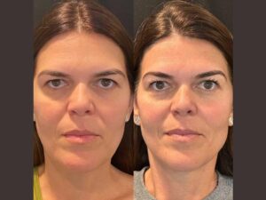 thread lift treatment Dubai