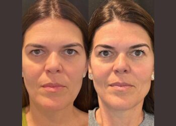 thread lift in Dubai