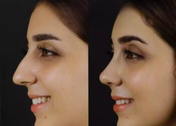 Septoplasty in dubai