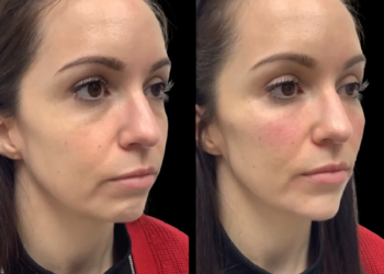 H1-Non-surgical-Facelift (1)