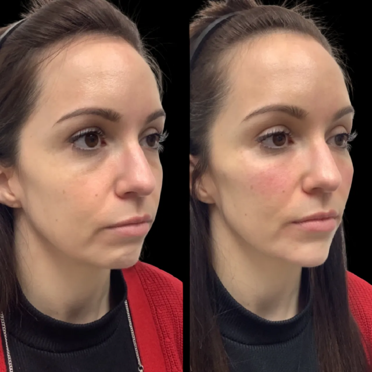 H1-Non-surgical-Facelift (1)