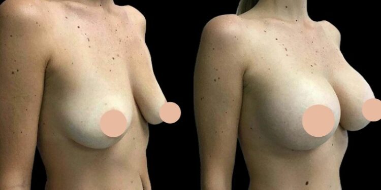 Understanding Longevity of Implants in Breast Augmentation Surgery in Dubai