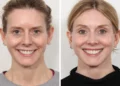 Common Thread Lift Questions Answered by the Best Plastic Surgeons in Dubai