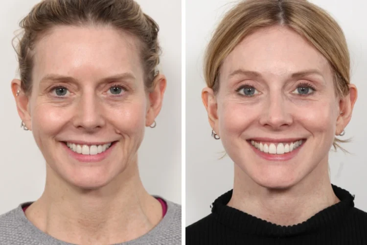 Common Thread Lift Questions Answered by the Best Plastic Surgeons in Dubai