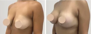 breast reduction in dubai