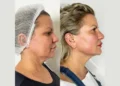 Double Chin Reduction Made Easy with Endolift at the Best Aesthetic Clinics in Dubai