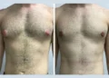 Why Consult a Specialist for Gynecomastia Surgery in Dubai