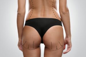 Butt fat transfer in dubai