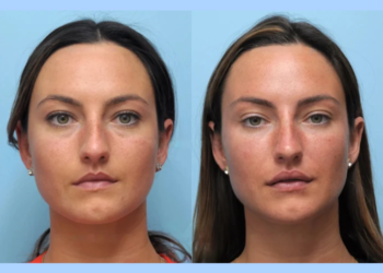 Explore the Art of Non-Surgical Lifting with the Best Doctors in Dubai for Thread Lift