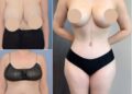 Tummy Tuck Surgery in Dubai