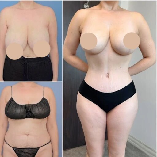 Tummy Tuck Surgery in Dubai