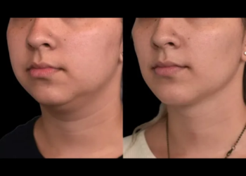 Double chin removal