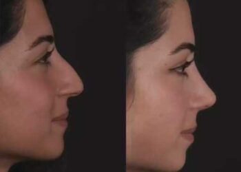 Septoplasty in Dubai
