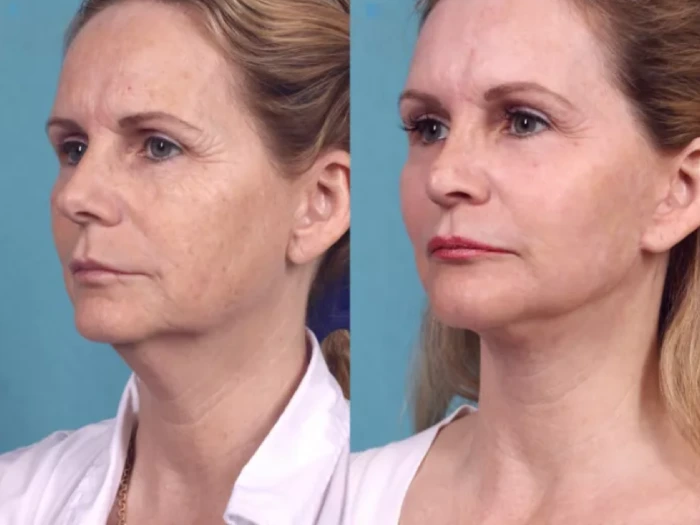 Chemical Peel for Every Skin Type: Advice from the Best Plastic Surgeon in Dubai