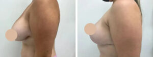 breast reduction in dubai