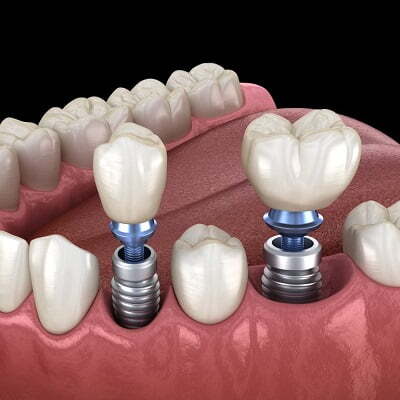 Dental implants in Islamabad