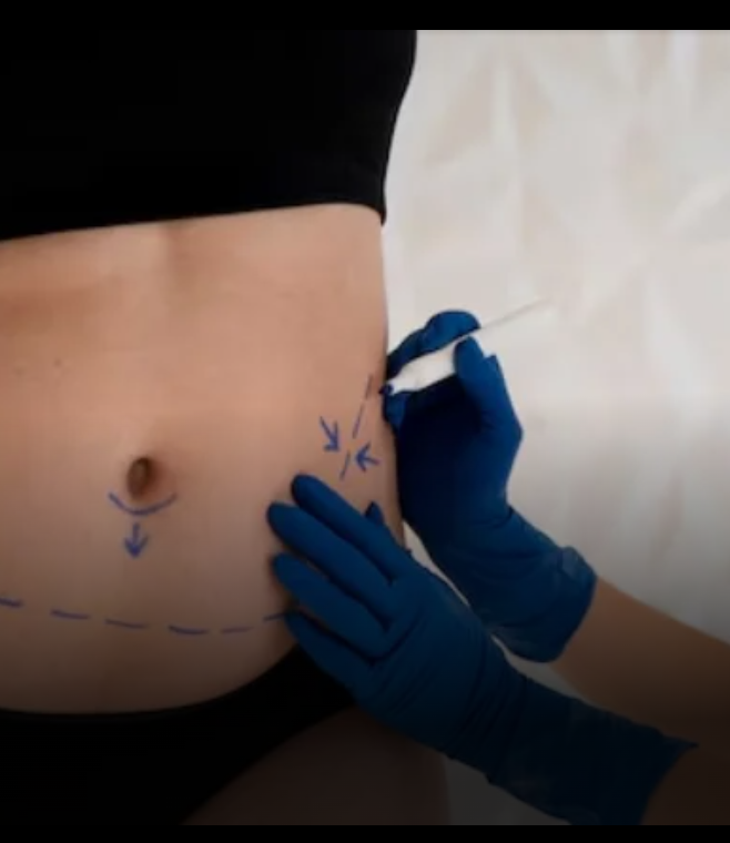 Abdomen Liposuction In Dubai