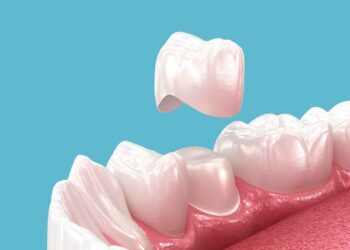 dental implants belfast