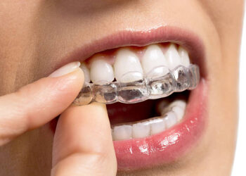 Transforming Smiles with Invisalign in Fort Collins: A Modern Approach to Orthodontic Care