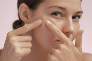 Pimples Treatment in Riyadh