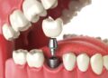 Restore Your Smile with Precision Using Single Dental Implants