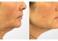 Feel Youthful and Confident Again with Thread Lift from Best Doctors in Dubai